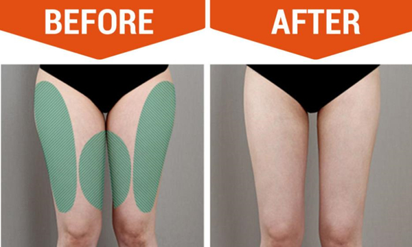 What is Thigh Liposuction?