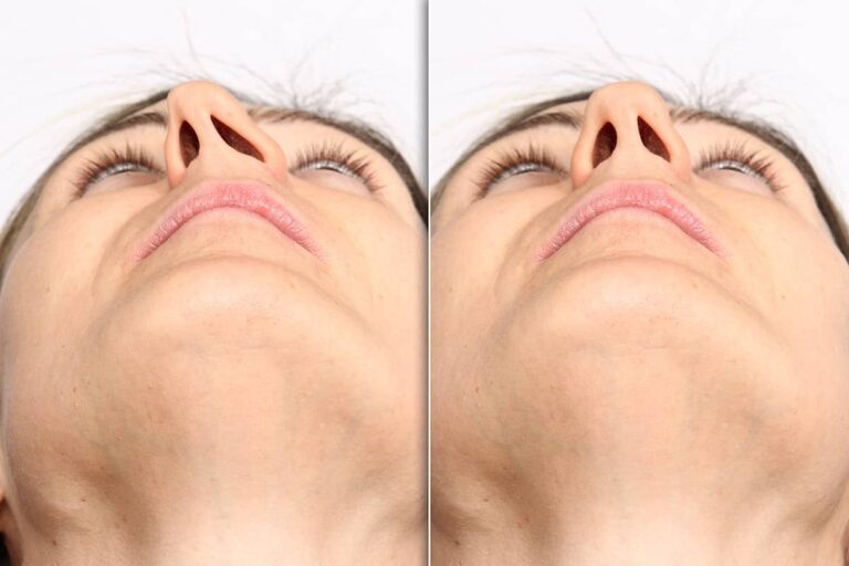  what is septoplasty