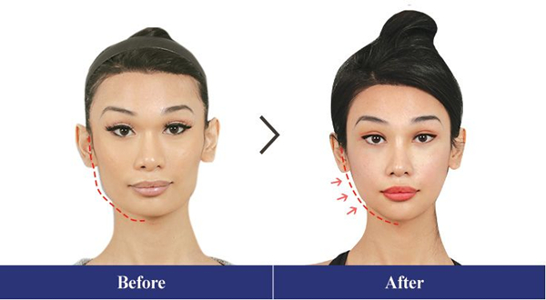 Facial Feminization Surgery