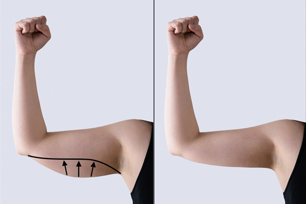 arm liposuction