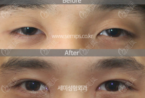 male double eyelid surgeries