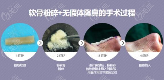 Advantages of GNG Plastic Surgery