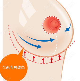 Breast Reduction