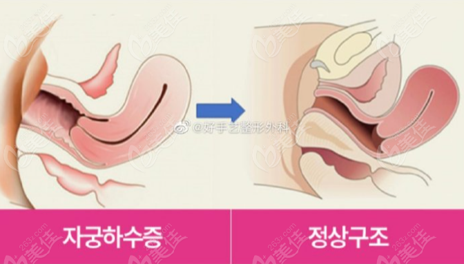 Posterior vaginal wall prolapse repair
