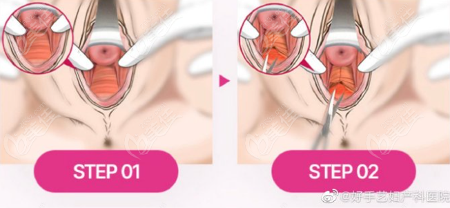 Miss vaginal rejuvenation