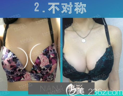 左右不对称