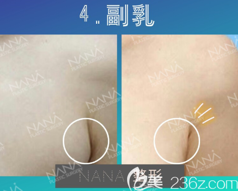 副乳切除