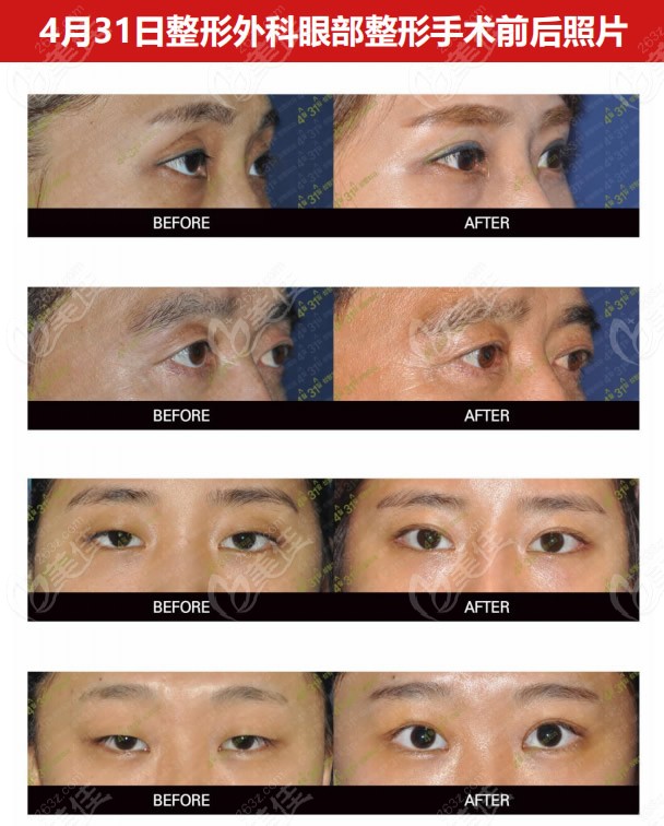 eye repair from 431 Plastic Surgery