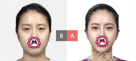 Examples of double eyelid surgery at TL Plastic Surgery
