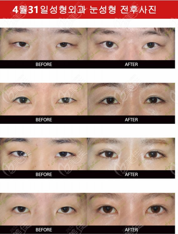 double eyelid surgery