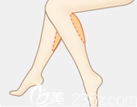 calf liposuction