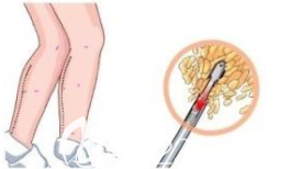 Can You Walk after Calf Liposuction?
