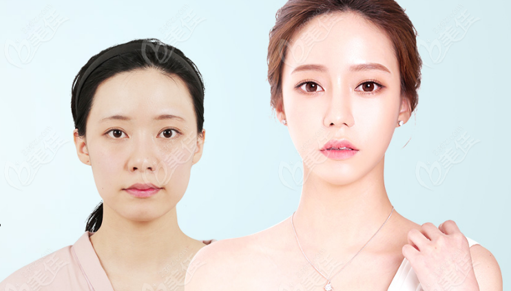facial contouring surgery