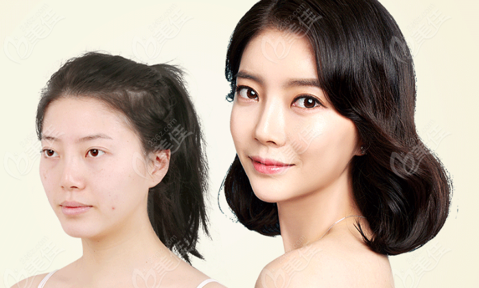  nose surgery