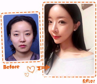 Facial Contouring