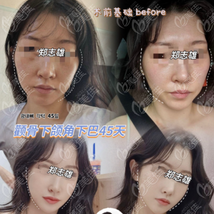 How is Dr. Zheng Zhixiong's mandibular contouring?