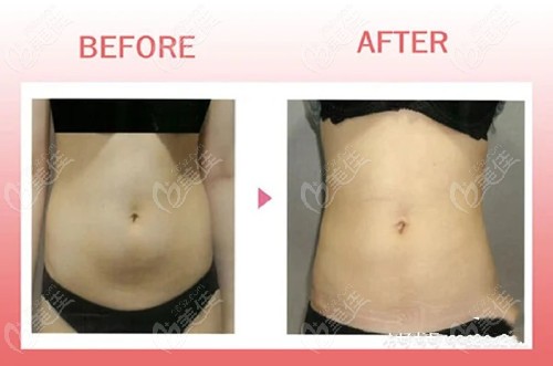 liposuction