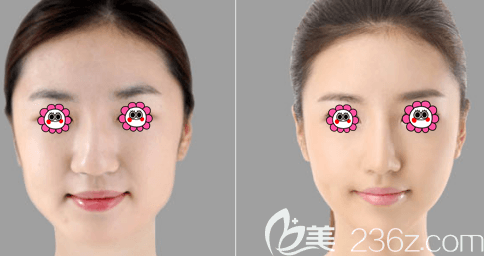  facial contouring