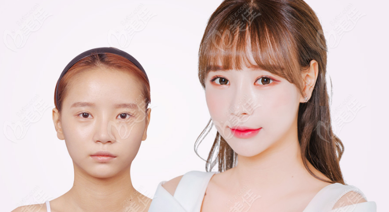 Good reputation for double eyelid surgery