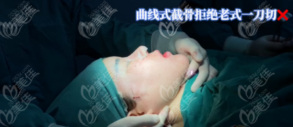 mandibular contouring