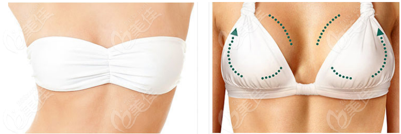 Breast Augmentation