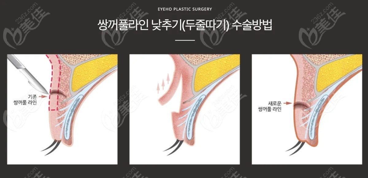 Everm Plastic Surgery excels in correcting multiple double eyelids