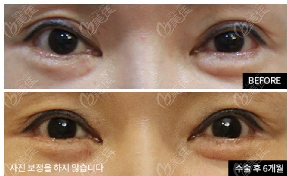 scarred eyelid repairs