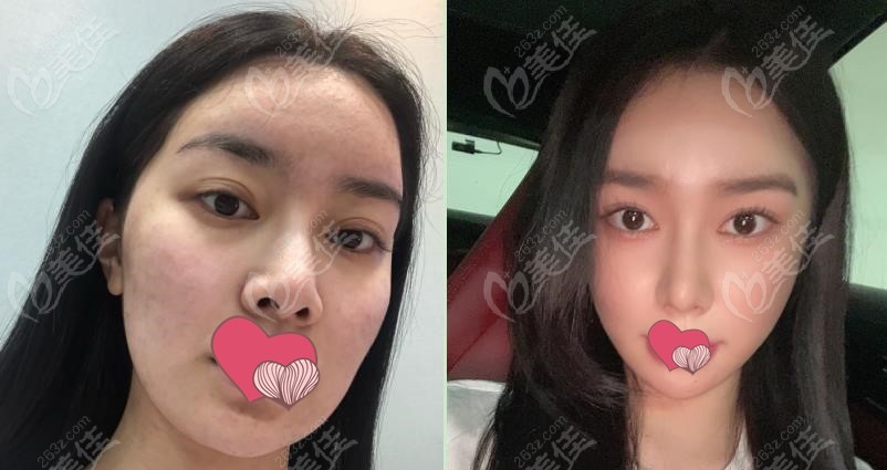 comparison photos of zygoma reduction