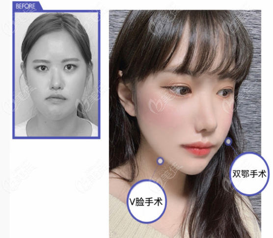Double Jaw Surgery