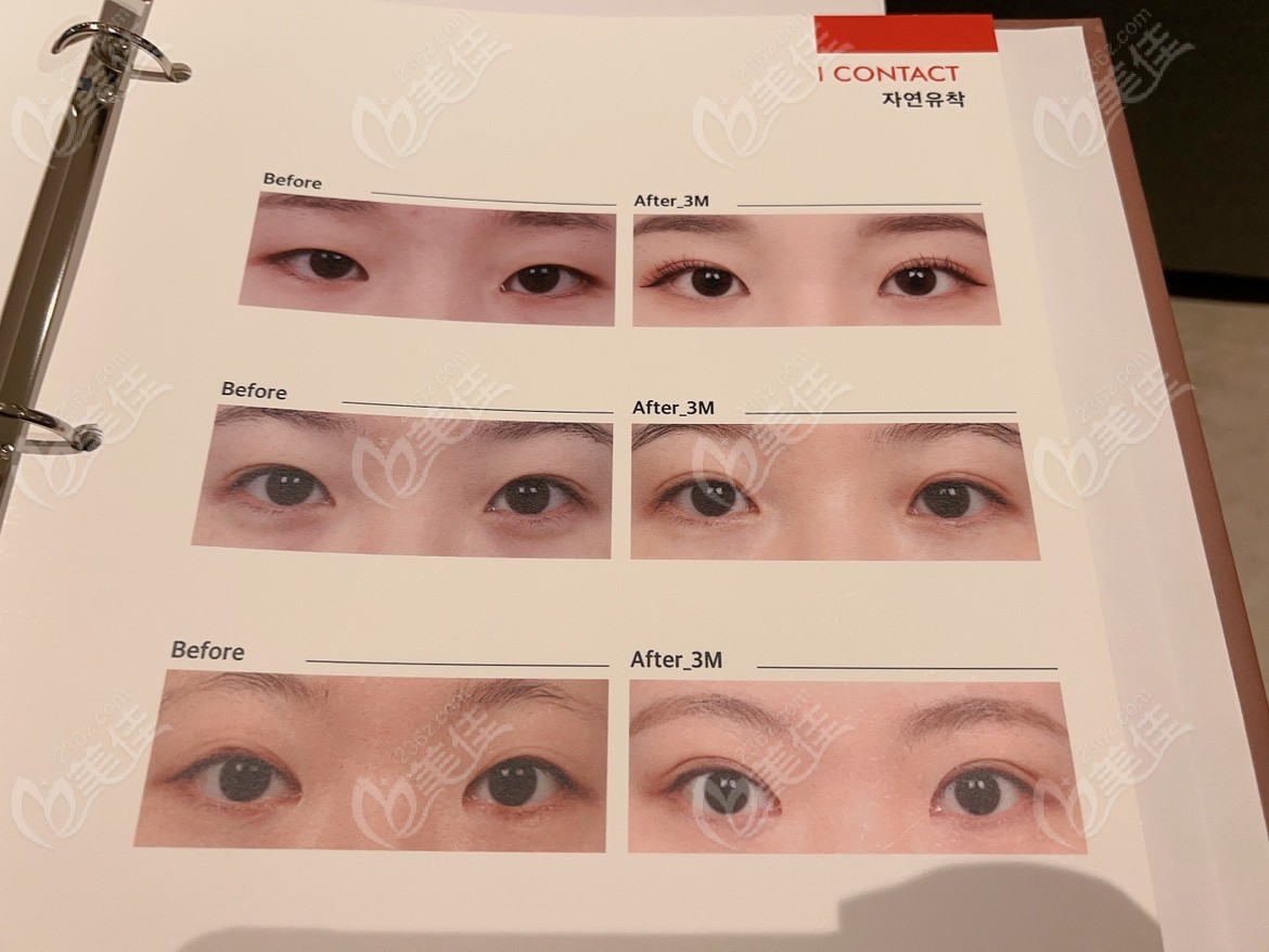 before and after