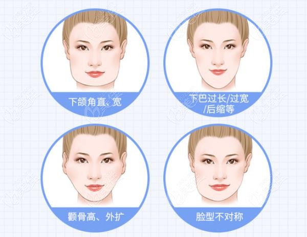 zygoma reduction surgery