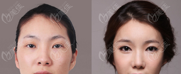 Rhinoplasty