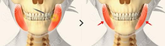 reduction of masseter muscle
