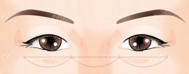 Double Eyelid Surgery
