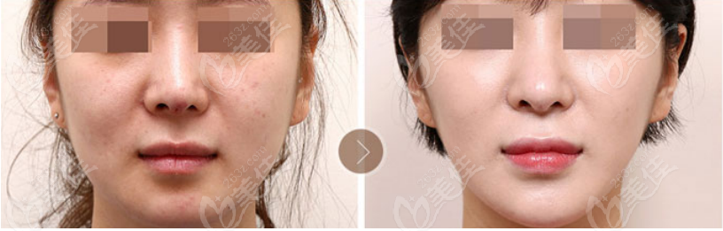 Facelift
