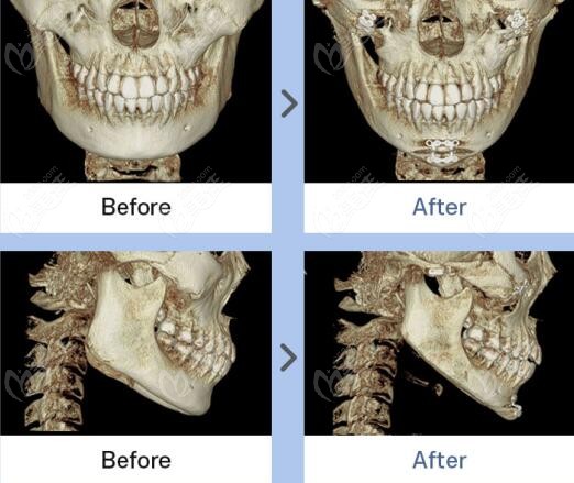 jaw angle contouring surgery