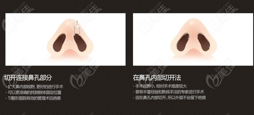 Nose procedures