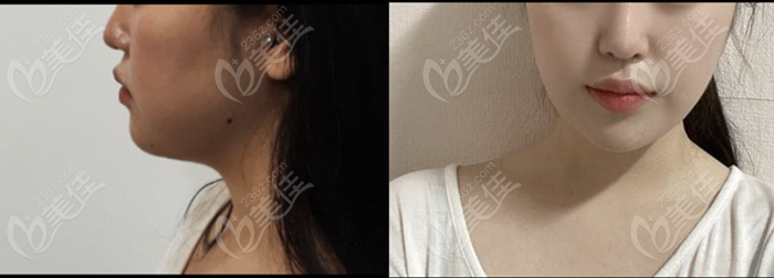 Power V facial liposuction + chin filling