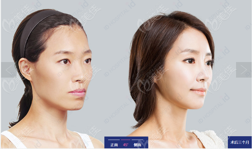 cheekbone surgery