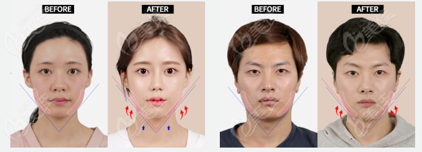 jaw angle surgery