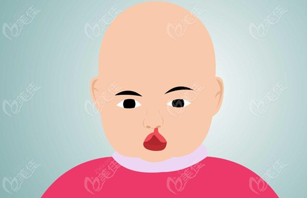 Cleft Lip Repair Surgery