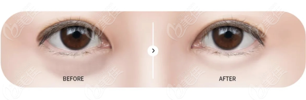 eye bag removal