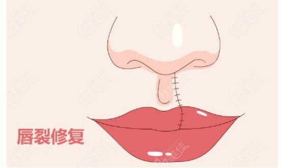 Cost of Cleft Lip Repair Surgery in Korea