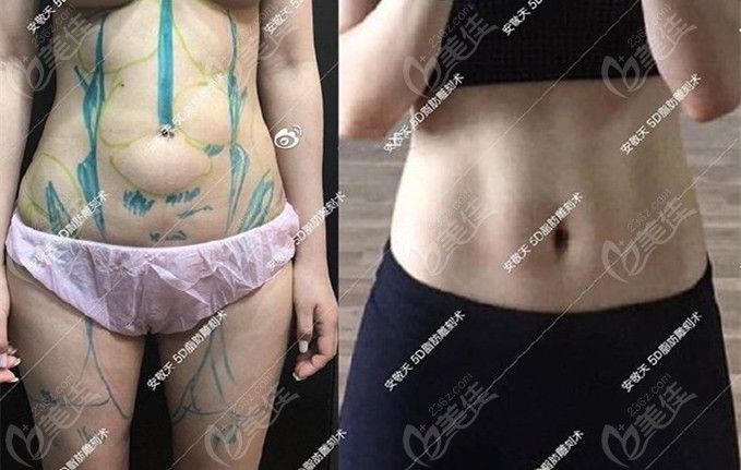 Failed Abdominal and Thigh Liposuction Repair