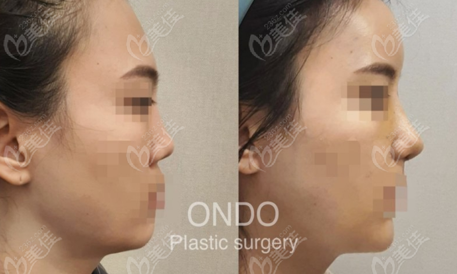 Nose job