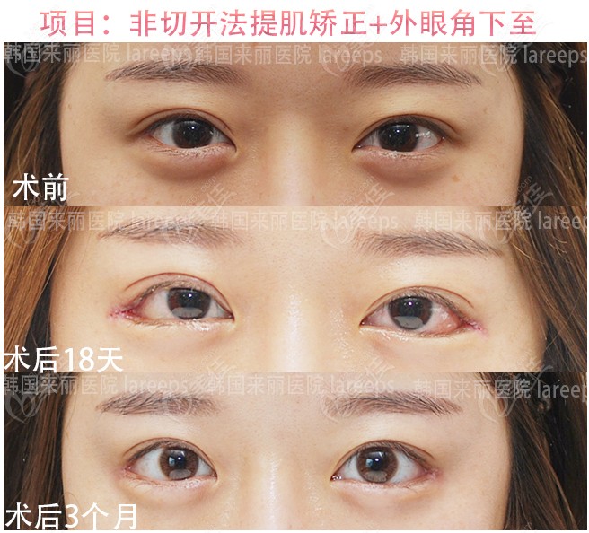 Non-incisional muscle correction and outer eye corner lower surgery