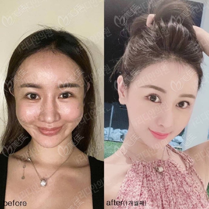 Fat Restoration Example 1: Facial Overfilling