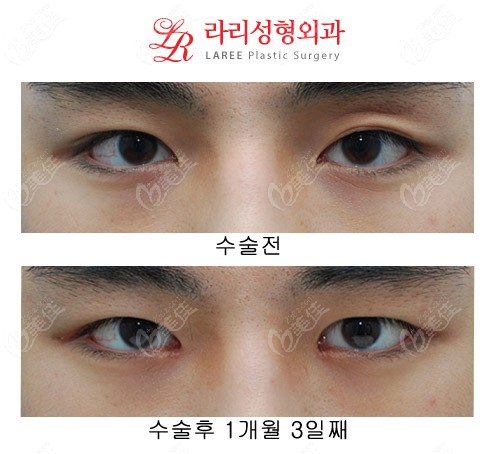 Double eyelid modification and anterior eye corner surgery