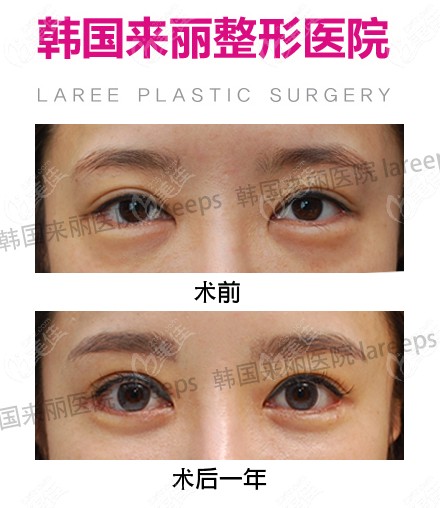 Double eyelid repair and comprehensive eye correction