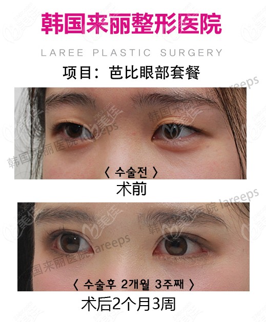 Comprehensive eye correction at Laree Plastic Surgery